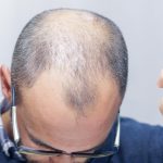 5 Cara Merawat Kulit Kepala yang Tak Kalah Penting untuk Pria