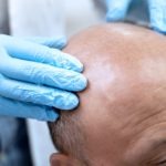 7 Perawatan Untuk Kepala Botak yang Mudah